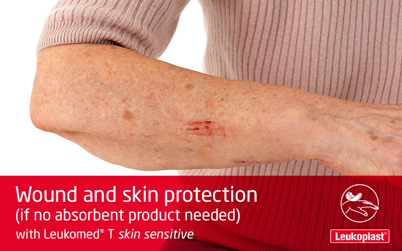 Denne video viser, hvordan en transparent sårbandage med film bruges på skrøbelig hud: vi ser en sundhedspersons hænder, der sætter Leukomed T skin sensitive på en rift på en ældre kvindes underarm. Denne video viser, hvordan en transparent sårbandage med film bruges på skrøbelig hud: vi ser en sundhedspersons hænder, der sætter Leukomed T skin sensitive på en rift på en ældre kvindes underarm.